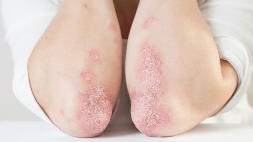 Psoriasis symptoms showing red scaly patches